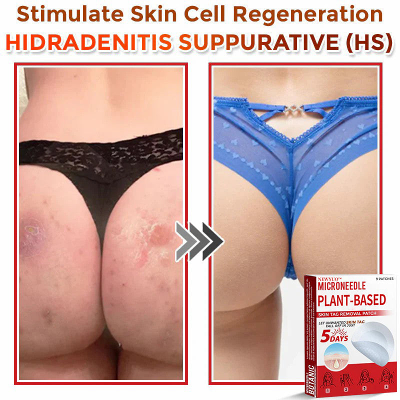 MicroNeedle Plant-based Skin Tag Removal Patch 🇺🇸