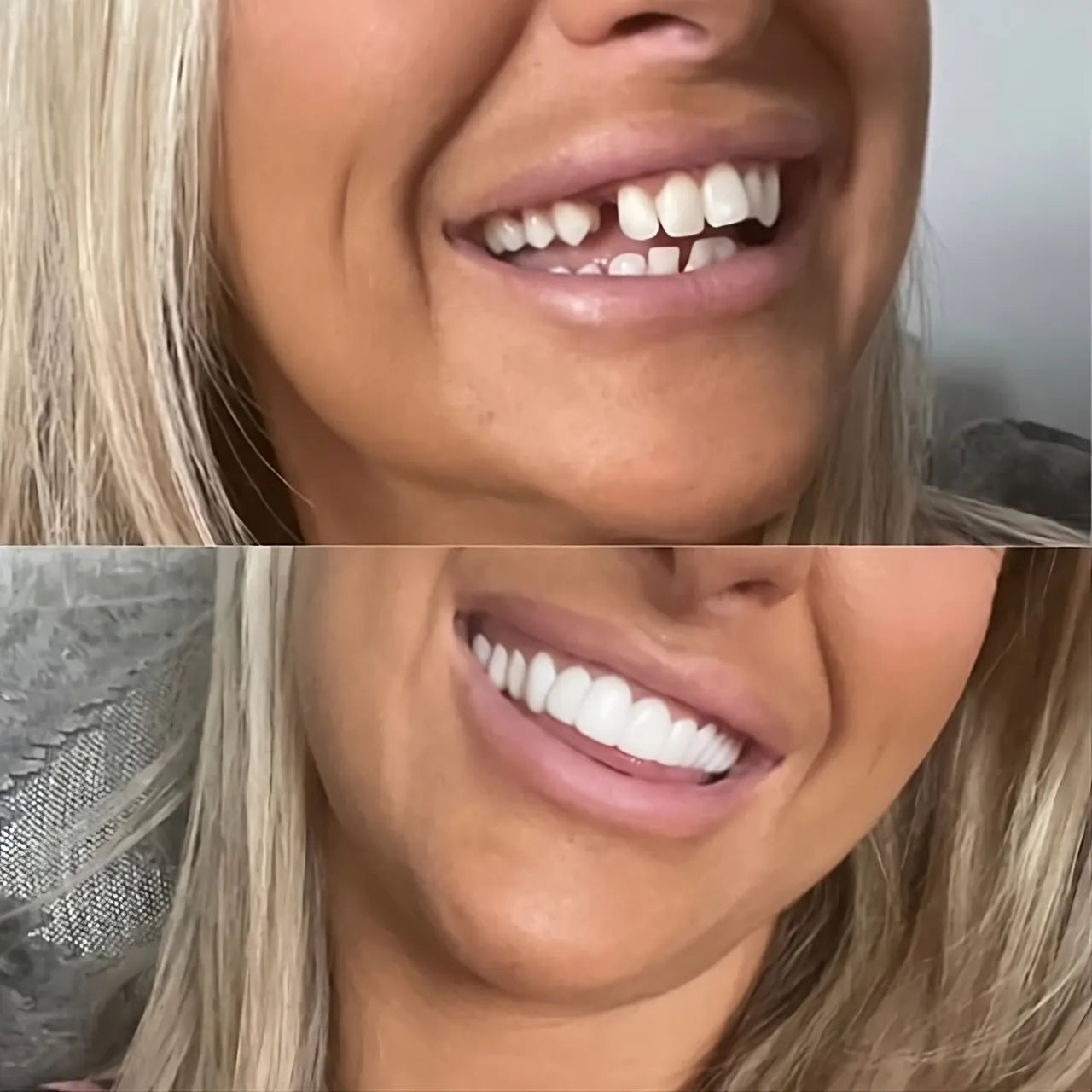Zaho™ Clip-on Veneers