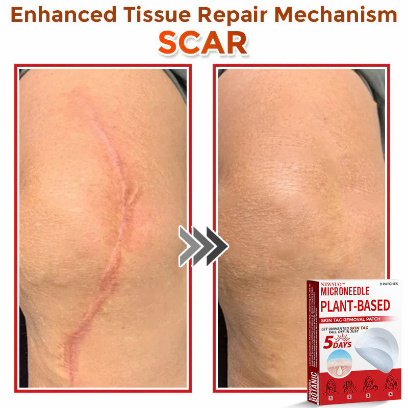 MicroNeedle Plant-based Skin Tag Removal Patch 🇺🇸