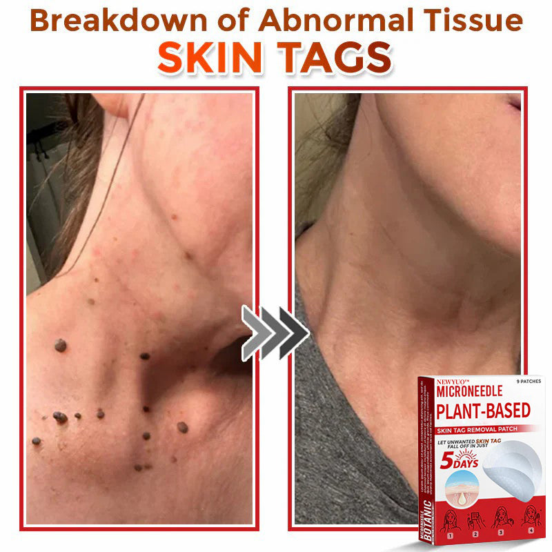 MicroNeedle Plant-based Skin Tag Removal Patch 🇺🇸