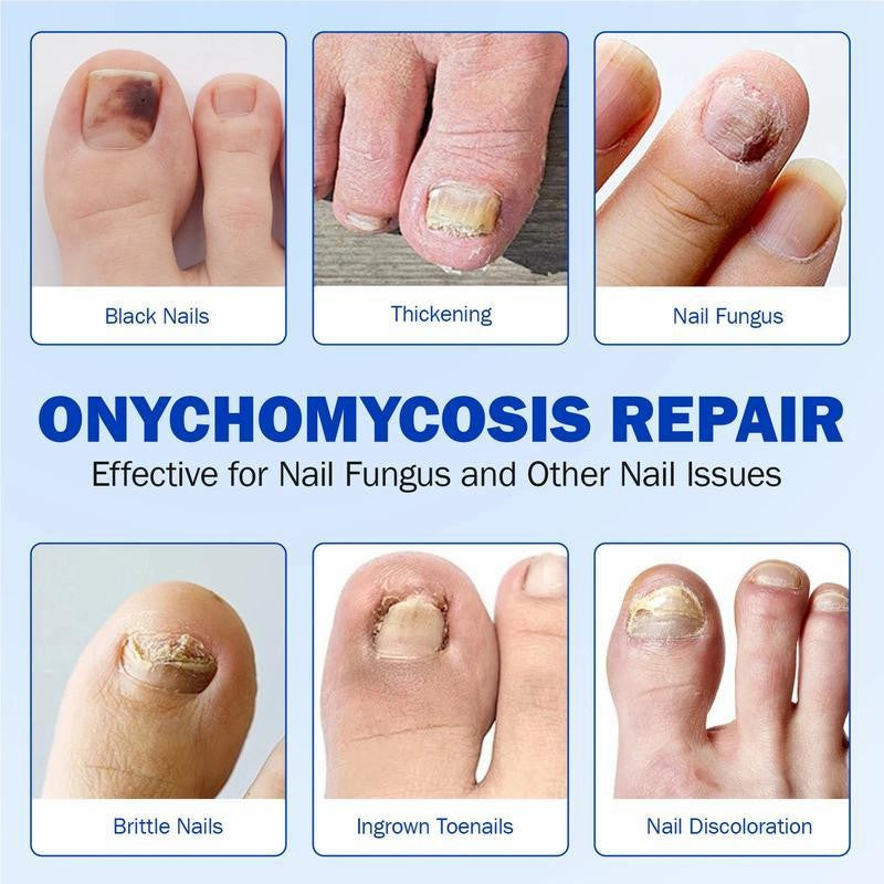 Fungal Nails? This Patch Solves It with Ease! ✅21pcs/box