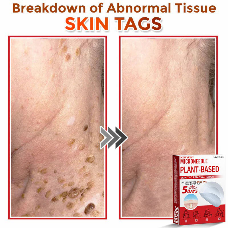 MicroNeedle Plant-based Skin Tag Removal Patch 🇺🇸