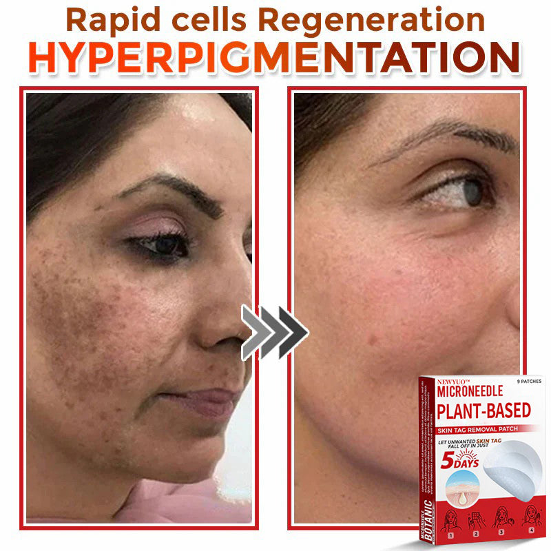 MicroNeedle Plant-based Skin Tag Removal Patch 🇺🇸