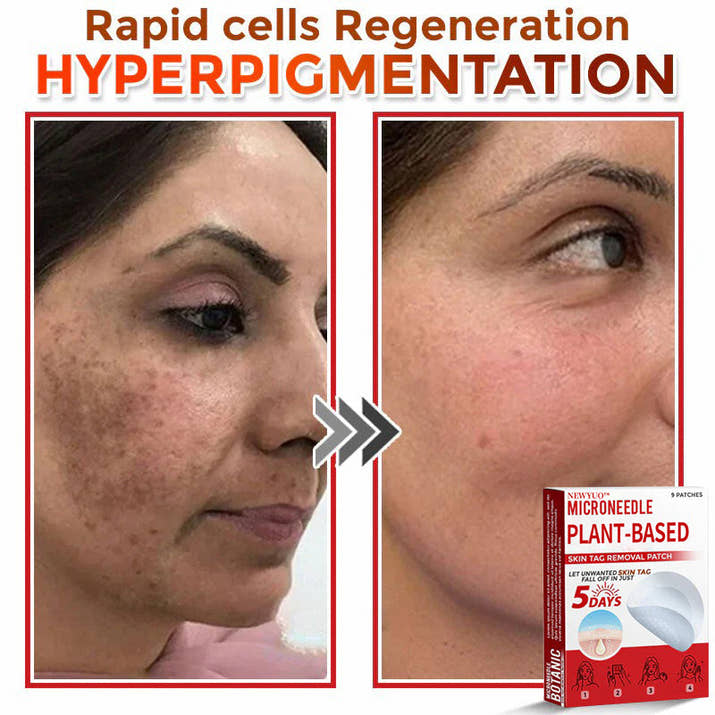 MicroNeedle Plant-based Skin Tag Removal Patch 🇺🇸
