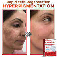 MicroNeedle Plant-based Skin Tag Removal Patch 🇺🇸