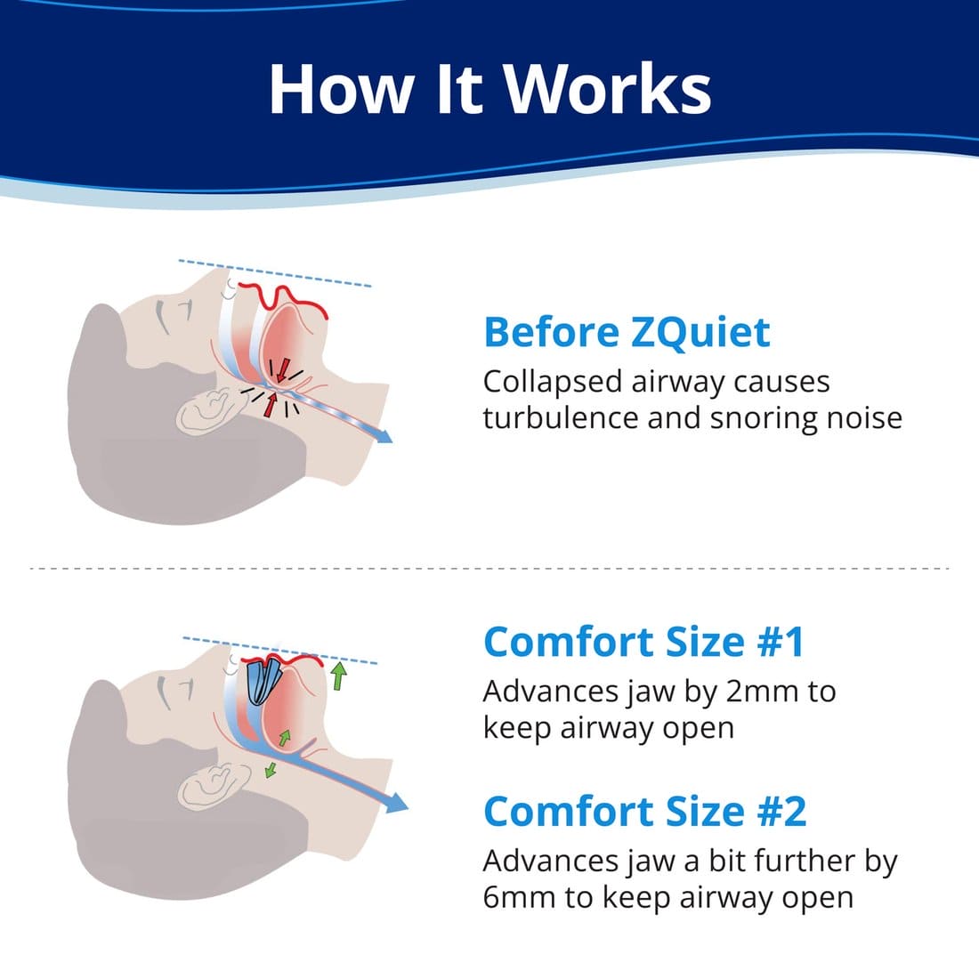 Anti-Snoring Mouthpiece