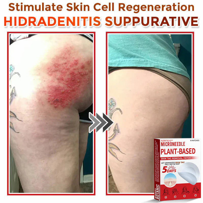 MicroNeedle Plant-based Skin Tag Removal Patch 🇺🇸