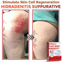 MicroNeedle Plant-based Skin Tag Removal Patch 🇺🇸