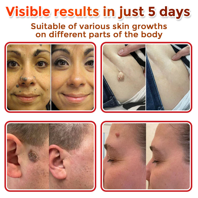 MicroNeedle Plant-based Skin Tag Removal Patch 🇺🇸